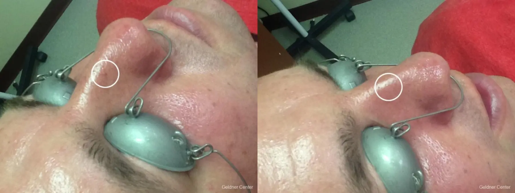 Laser-for-men: Patient 3 - Before and After  