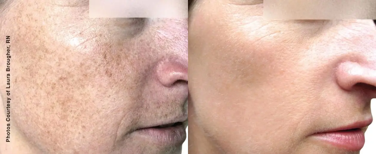 Laser For Men: Patient 1 - Before and After 1