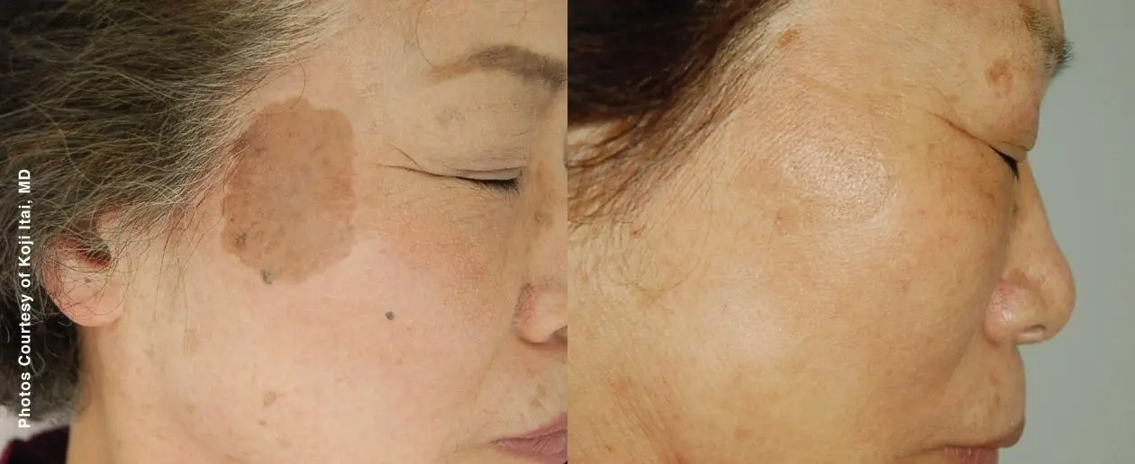 Laser: Patient 3 - Before and After 1