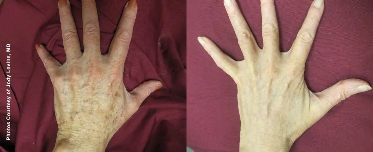 Laser: Patient 5 - Before and After  