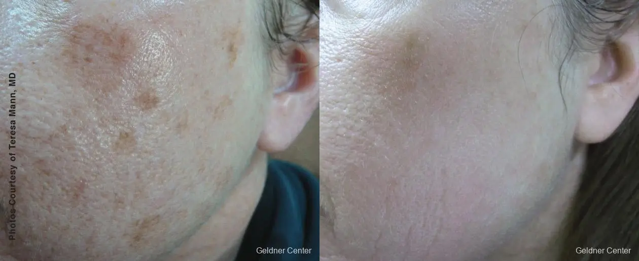 Laser: Patient 6 - Before and After  