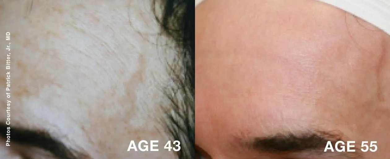 Laser: Patient 2 - Before and After  