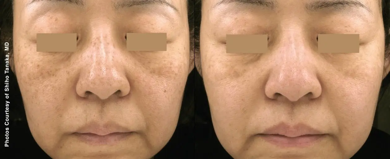 Laser: Patient 4 - Before and After  