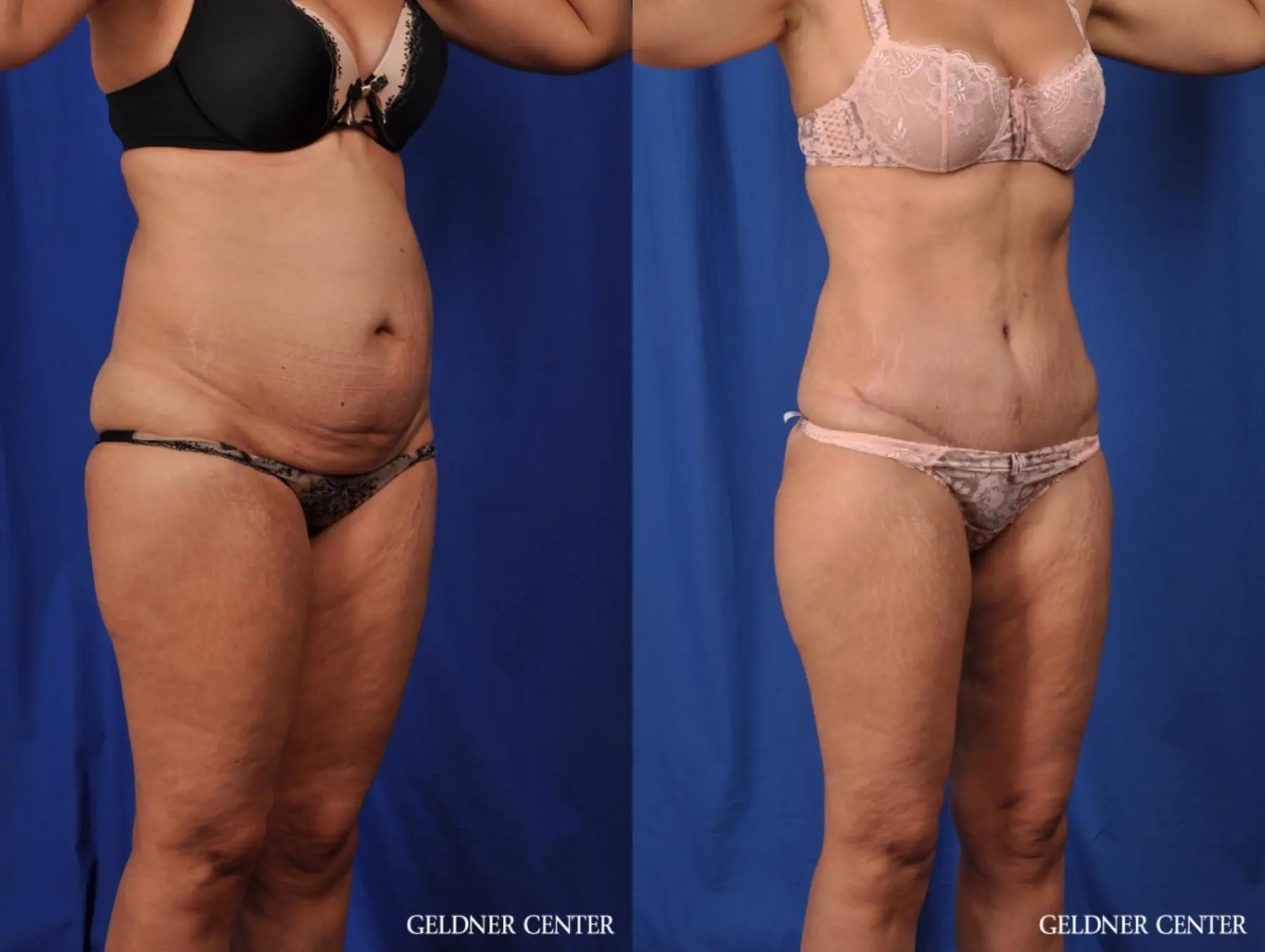 Lipoabdominoplasty: Patient 5 - Before and After 2