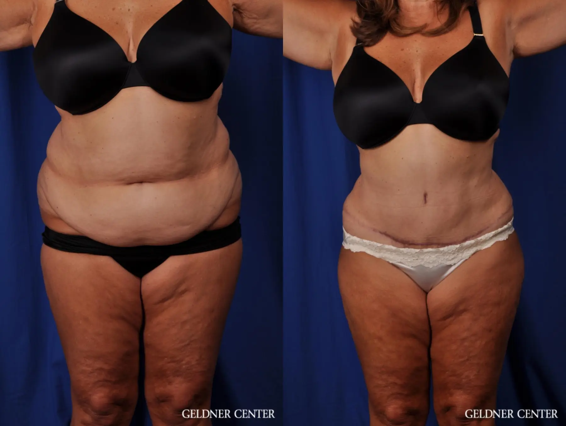 Lipoabdominoplasty: Patient 4 - Before and After  