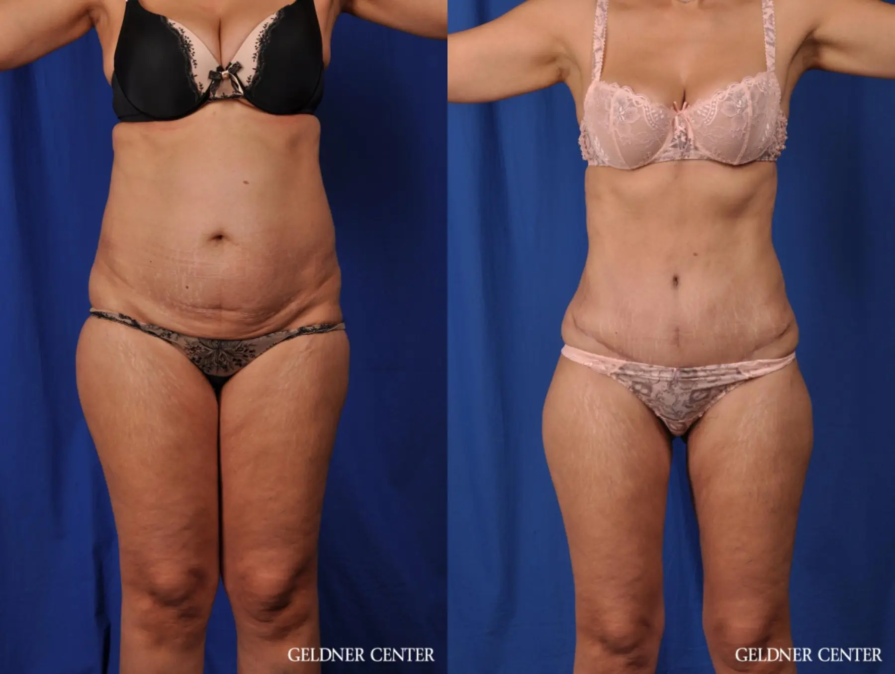 Lipoabdominoplasty: Patient 5 - Before and After  