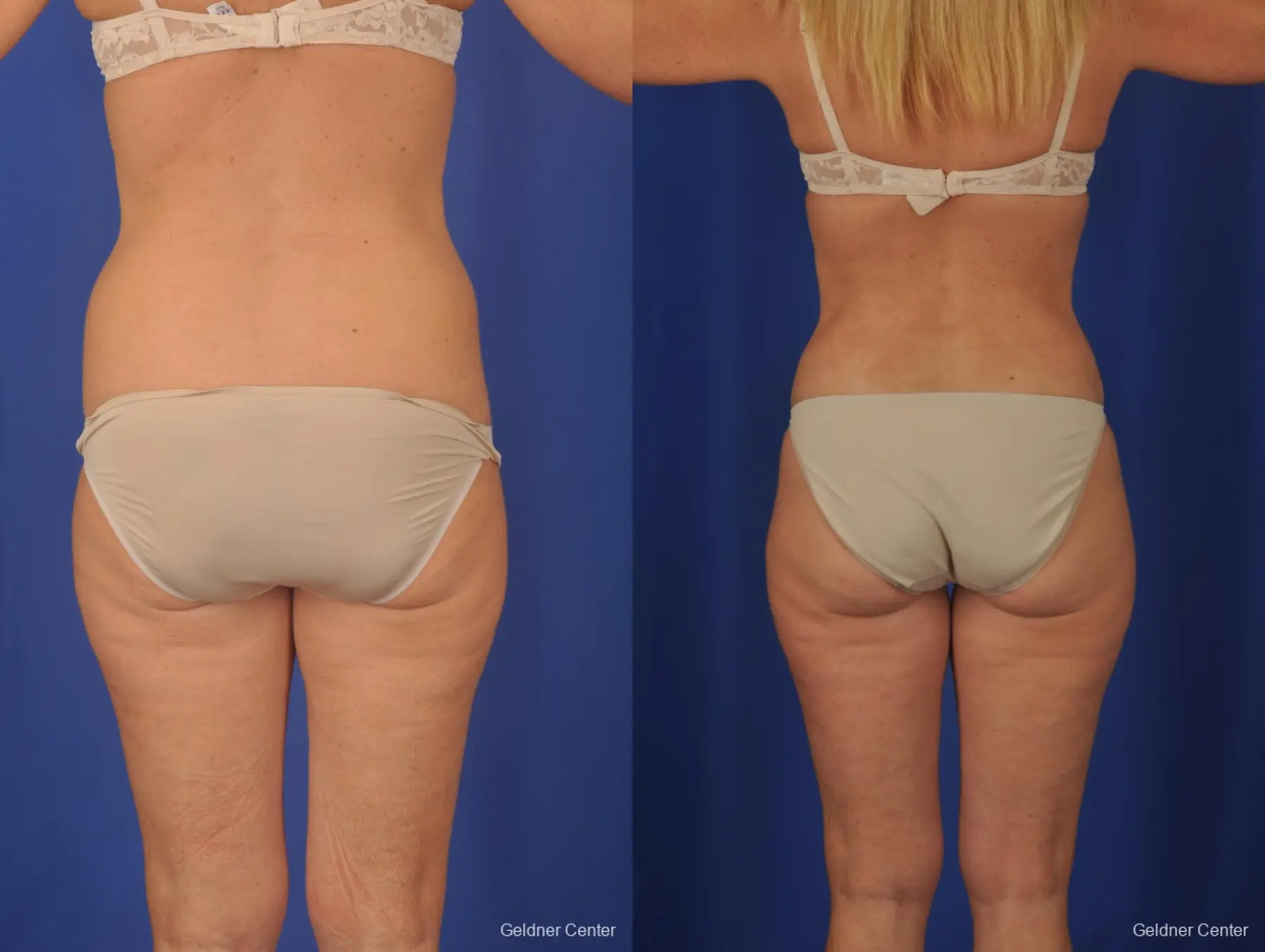 Lipoabdominoplasty: Patient 2 - Before and After 4