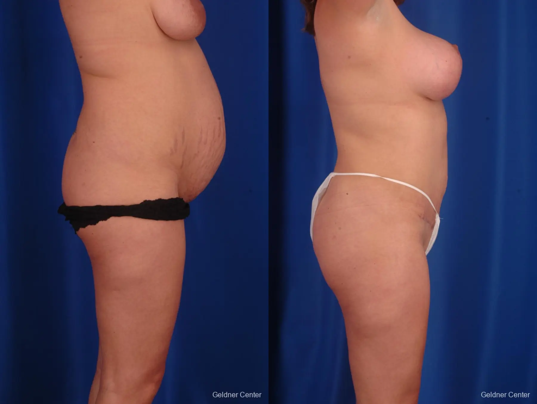 Lipoabdominoplasty: Patient 1 - Before and After 2