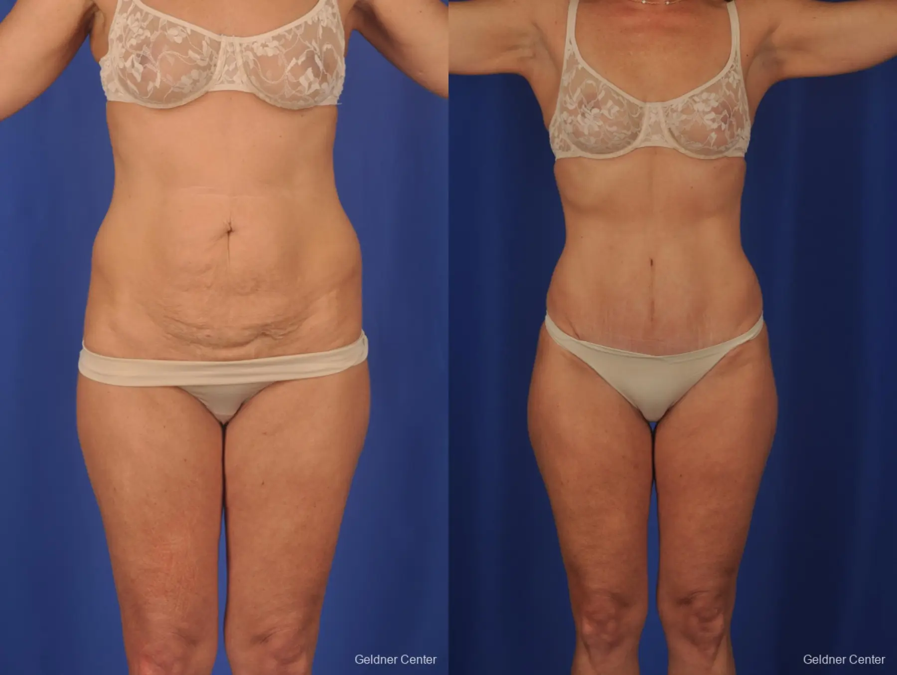 Lipoabdominoplasty: Patient 2 - Before and After 1