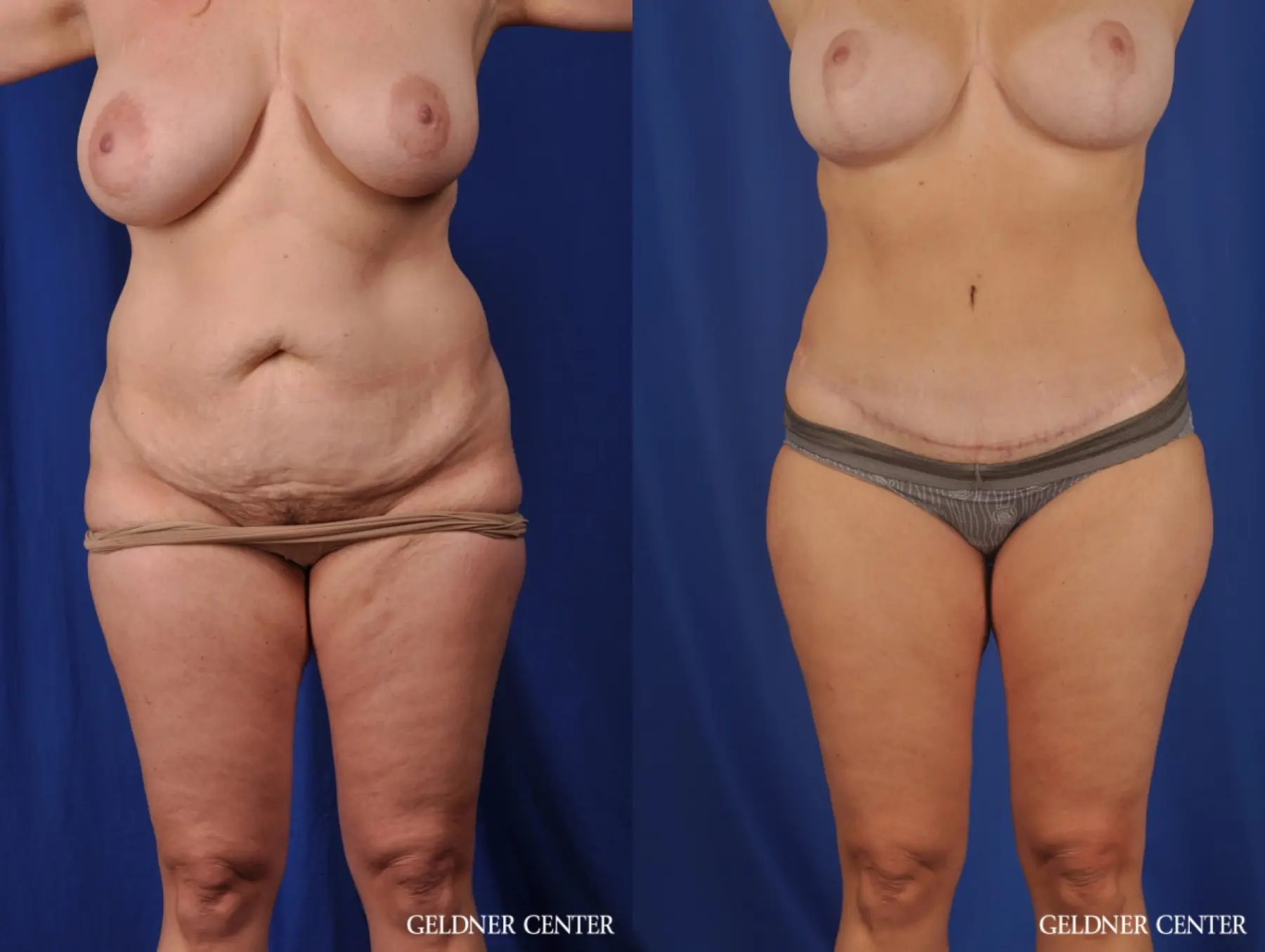 Lipoabdominoplasty: Patient 6 - Before and After  