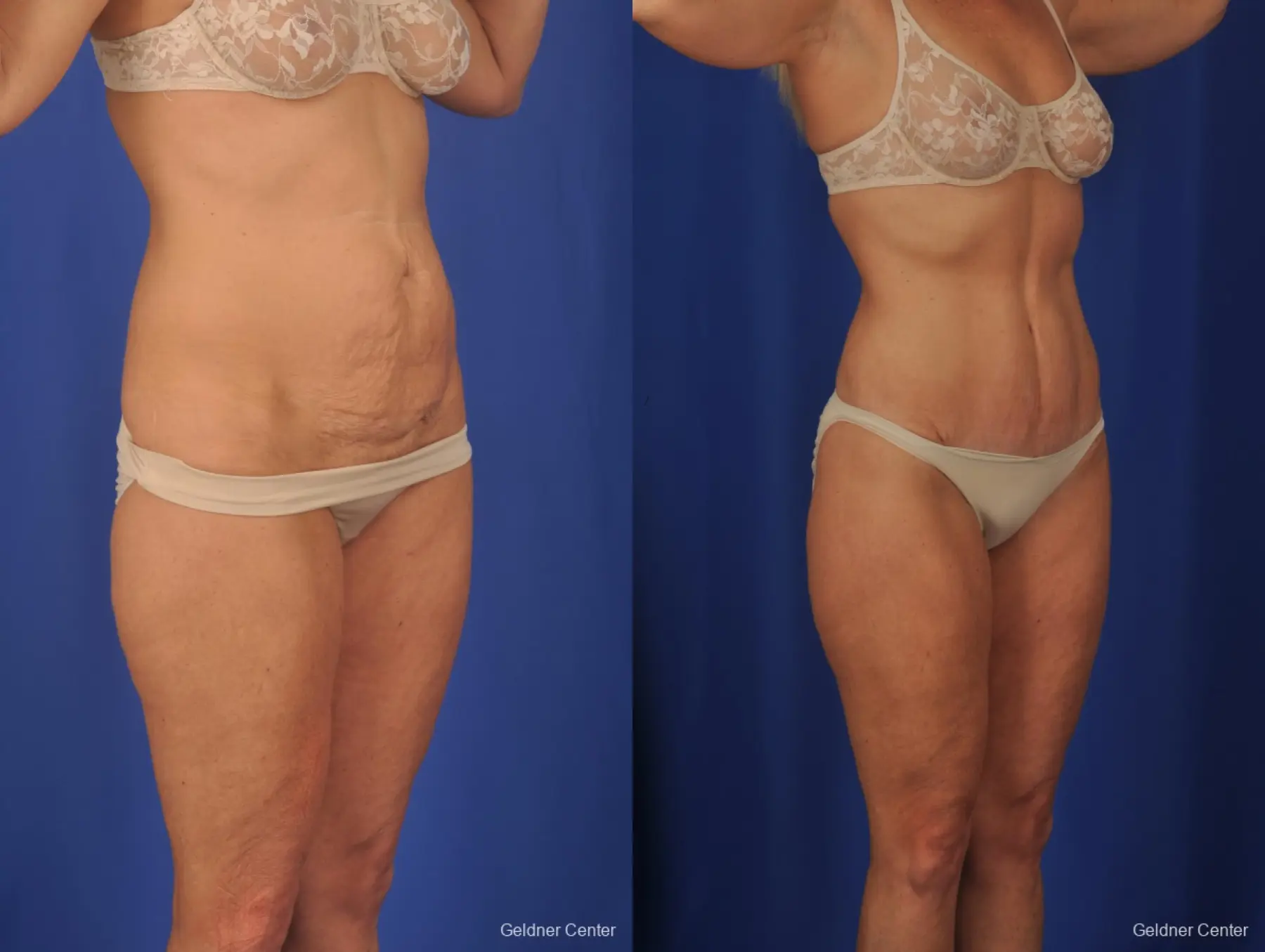 Lipoabdominoplasty: Patient 2 - Before and After 2