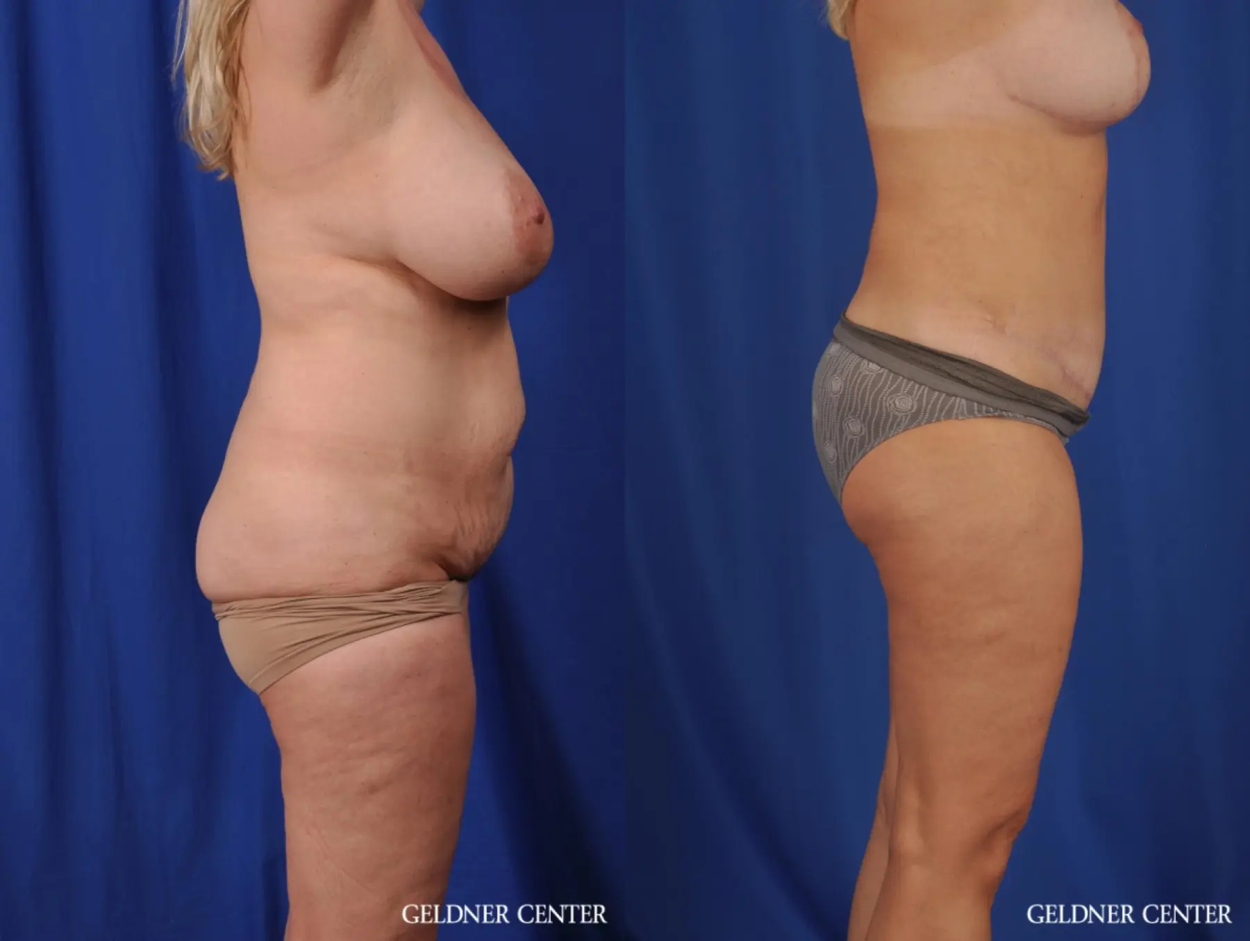 Lipoabdominoplasty: Patient 6 - Before and After 3