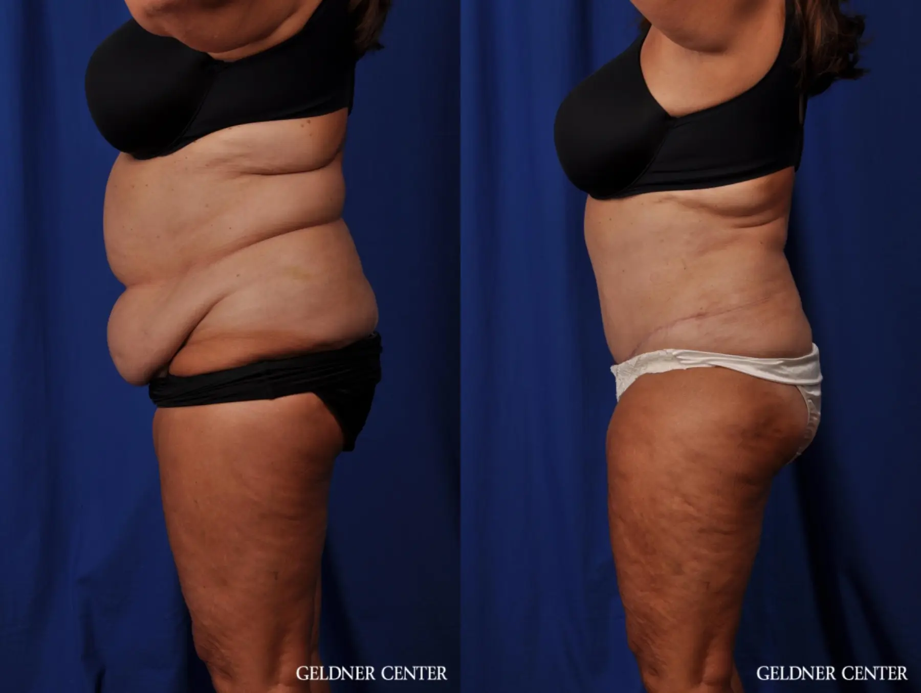 Lipoabdominoplasty: Patient 4 - Before and After 5