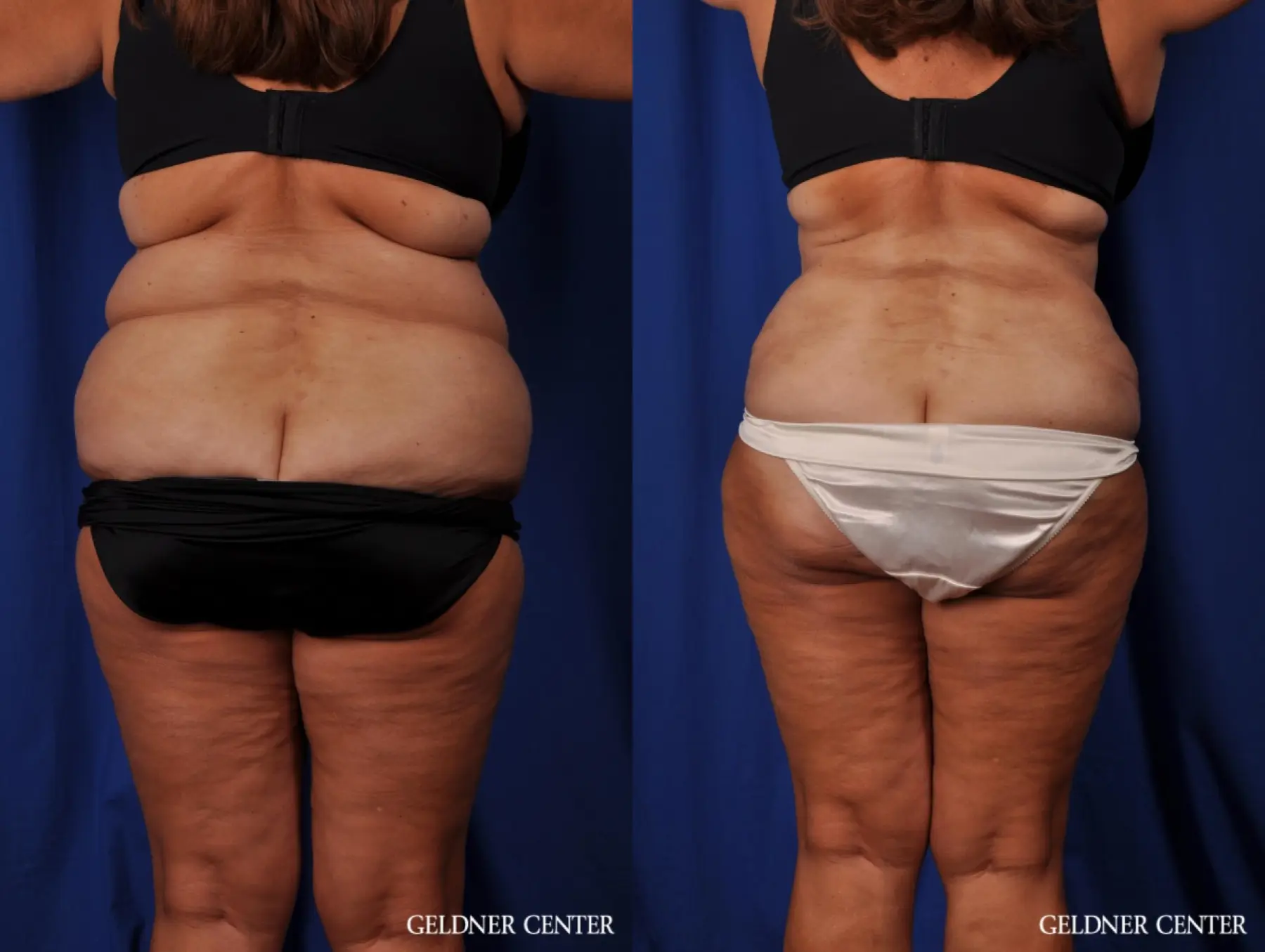 Lipoabdominoplasty: Patient 4 - Before and After 3