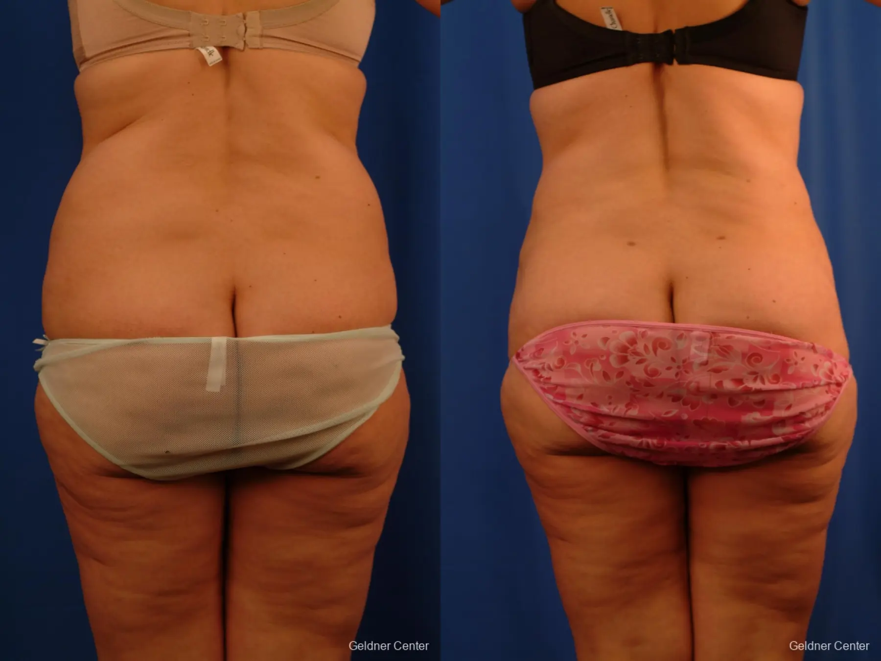 Lipoabdominoplasty: Patient 3 - Before and After 4