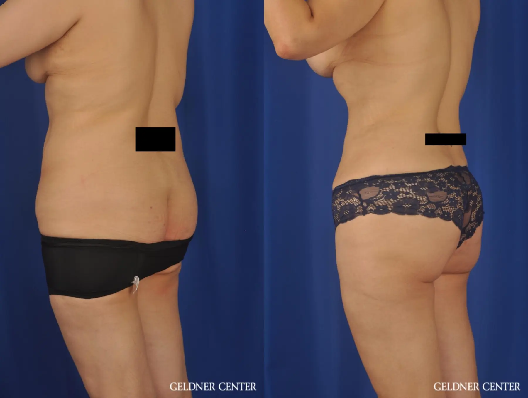Lipoabdominoplasty: Patient 7 - Before and After 5