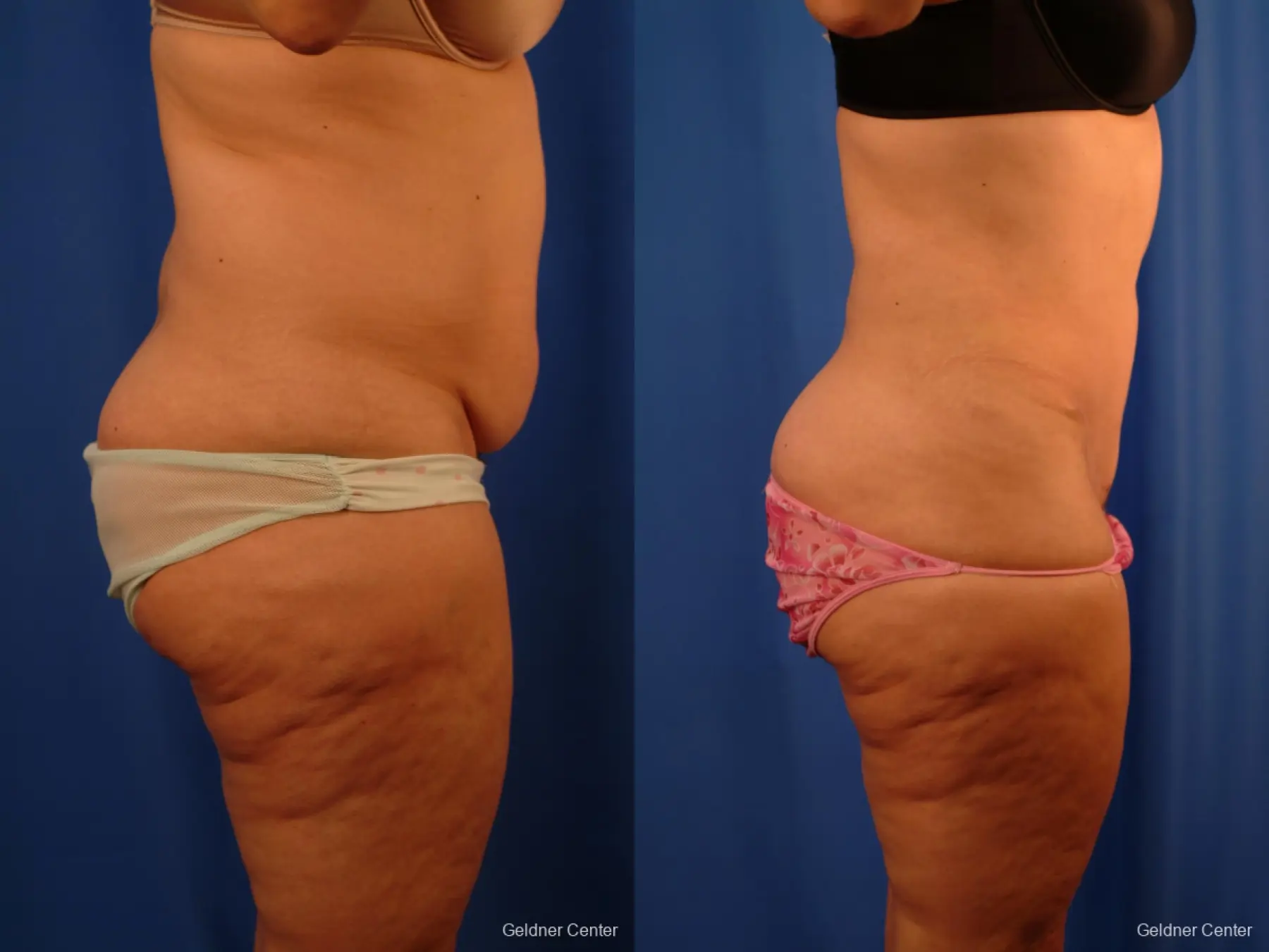 Lipoabdominoplasty: Patient 3 - Before and After 2