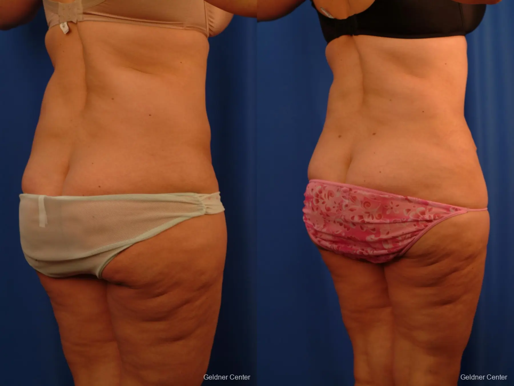 Lipoabdominoplasty: Patient 3 - Before and After 3