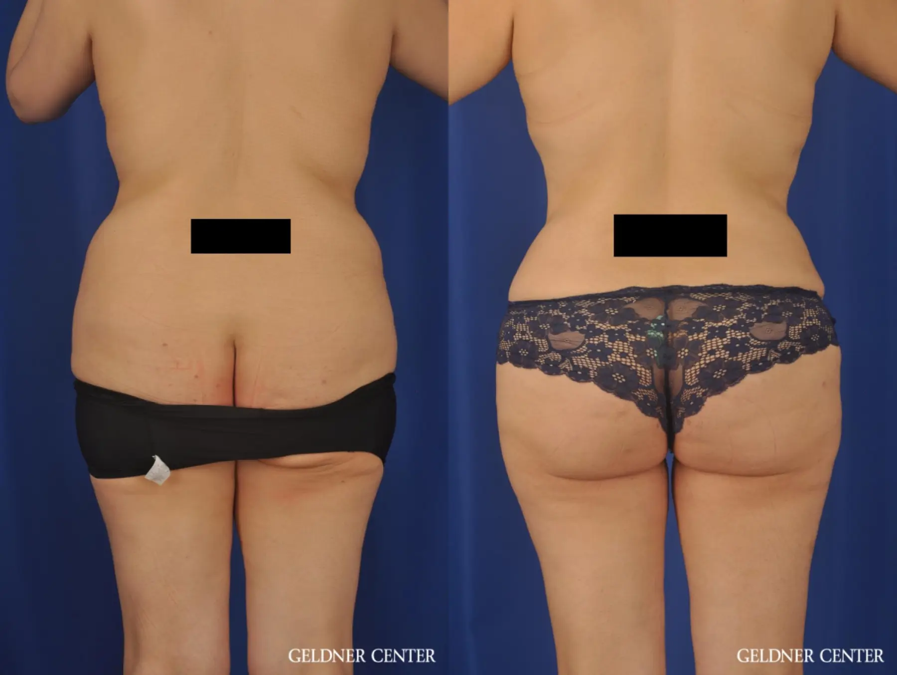 Lipoabdominoplasty: Patient 7 - Before and After 4