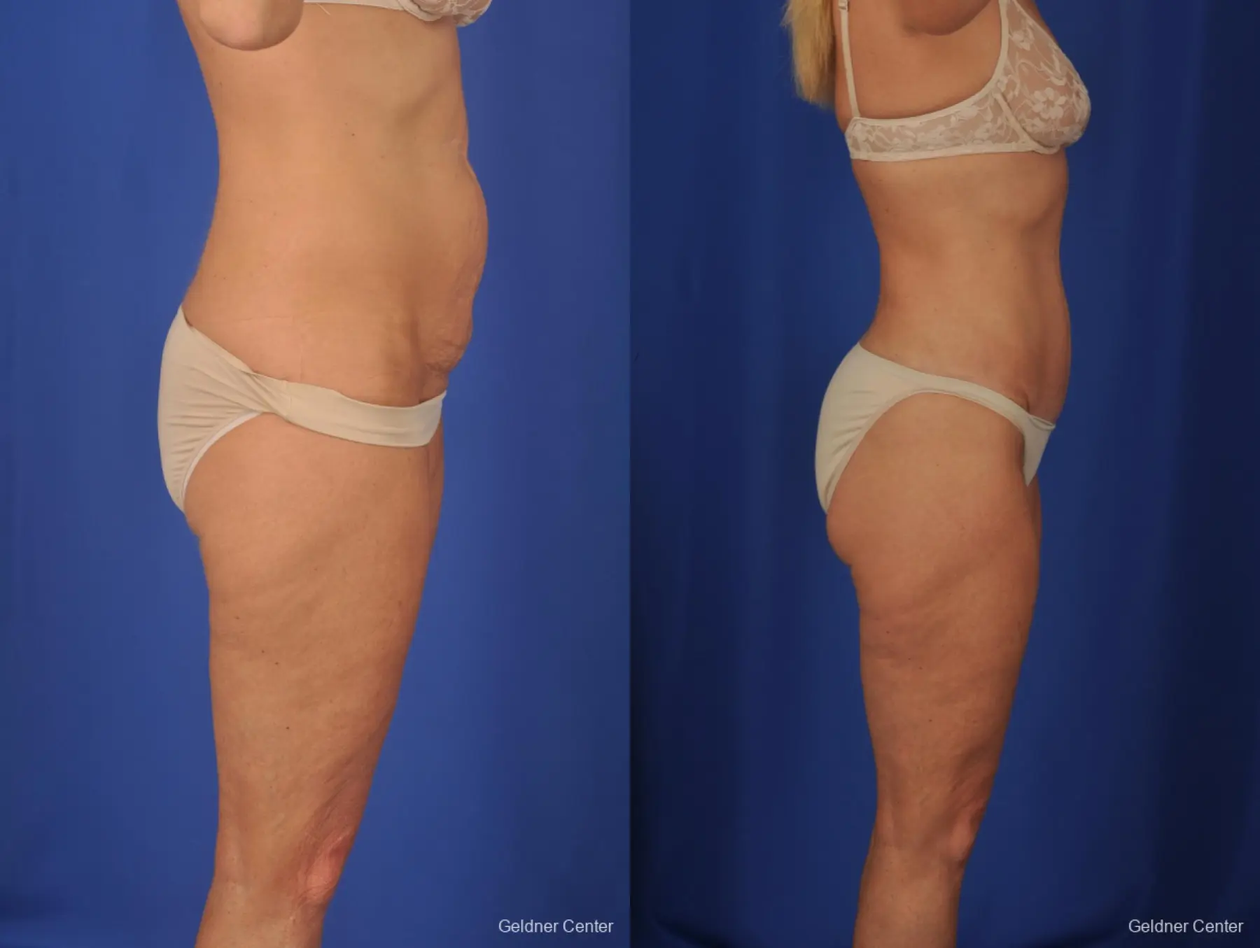 Lipoabdominoplasty: Patient 2 - Before and After 3