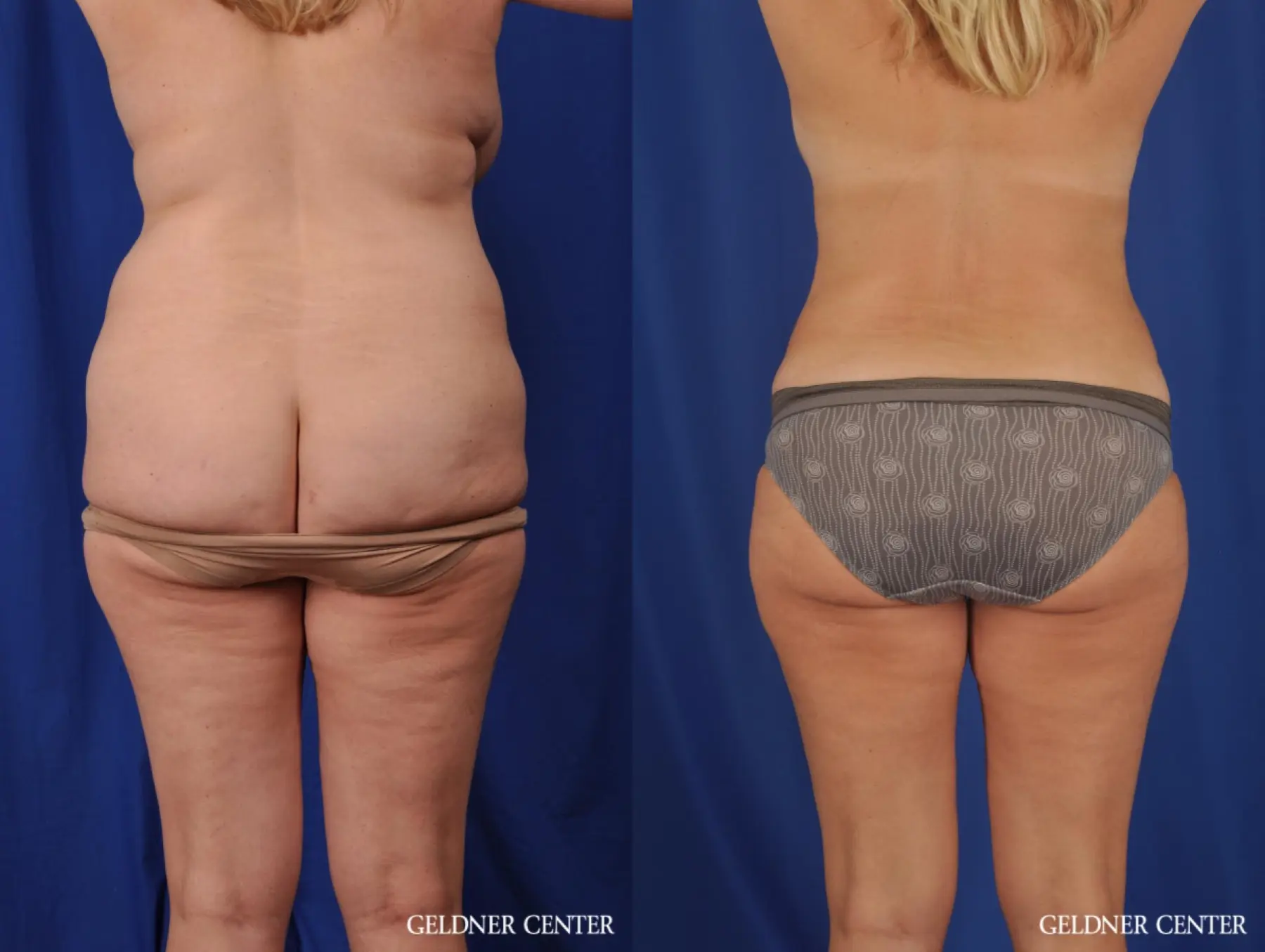 Lipoabdominoplasty: Patient 6 - Before and After 4