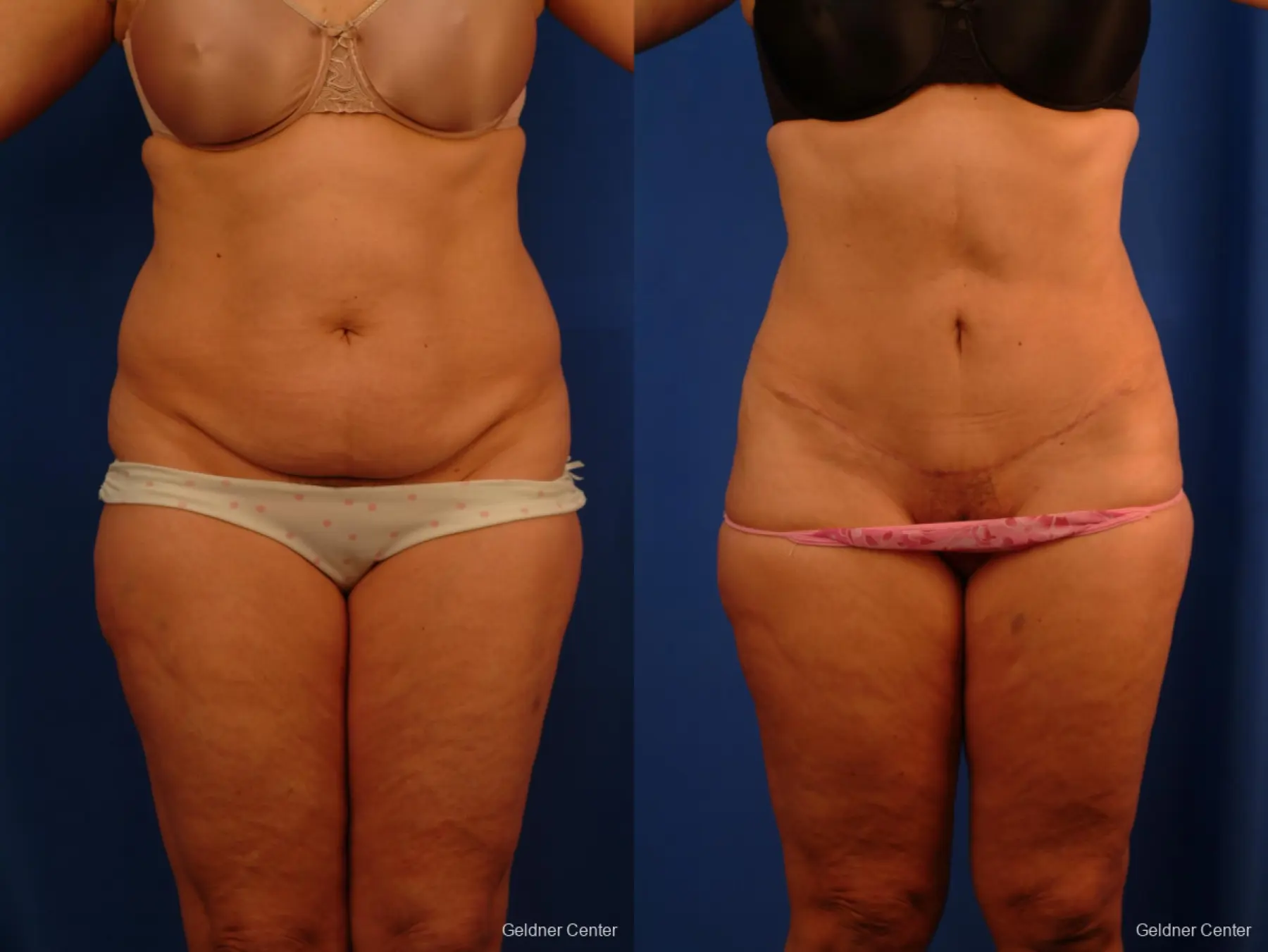 Lipoabdominoplasty: Patient 3 - Before and After 1