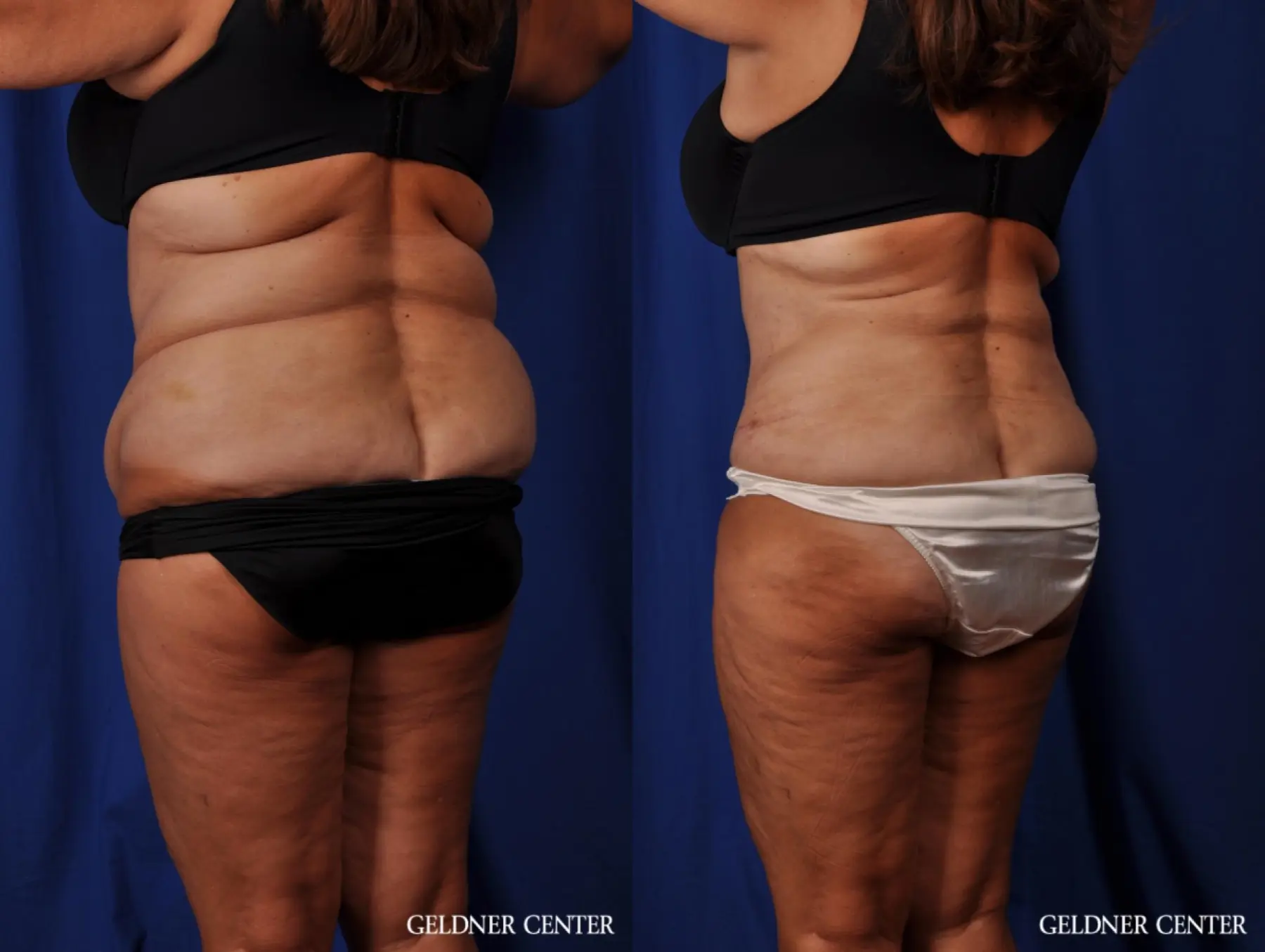 Lipoabdominoplasty: Patient 4 - Before and After 4