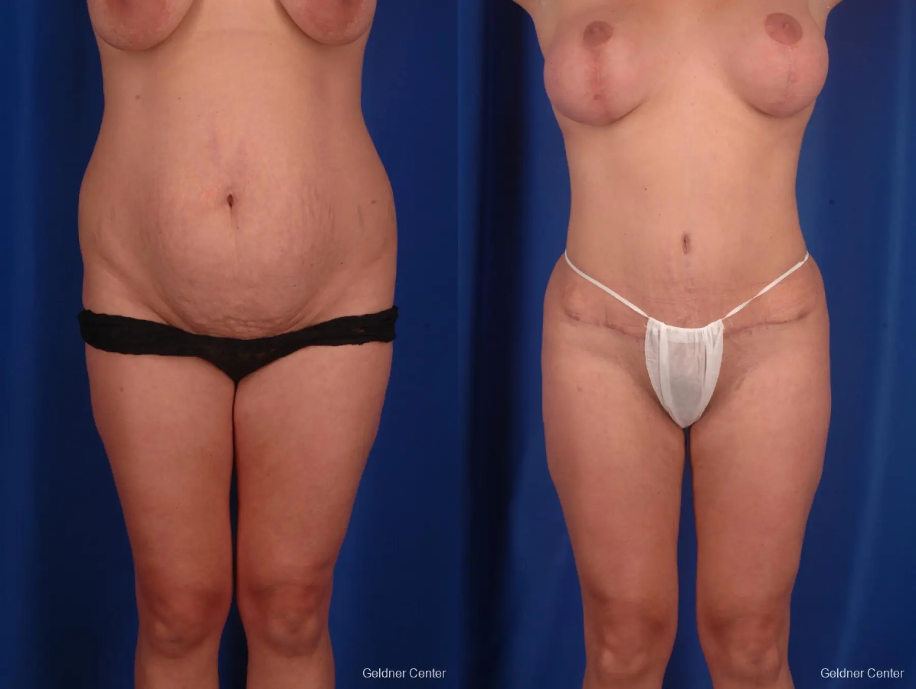 Lipoabdominoplasty: Patient 1 - Before and After 1