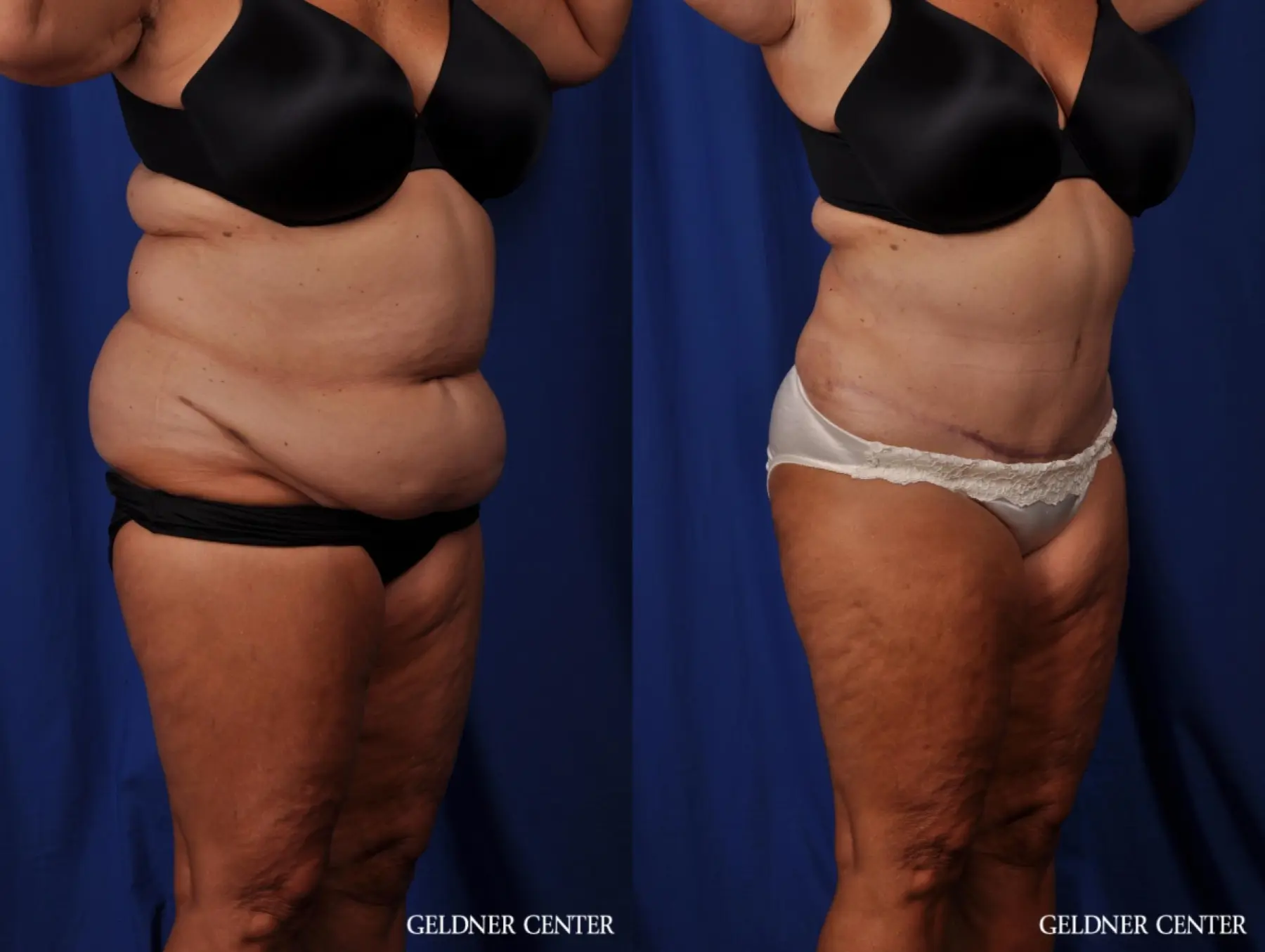 Lipoabdominoplasty: Patient 4 - Before and After 2