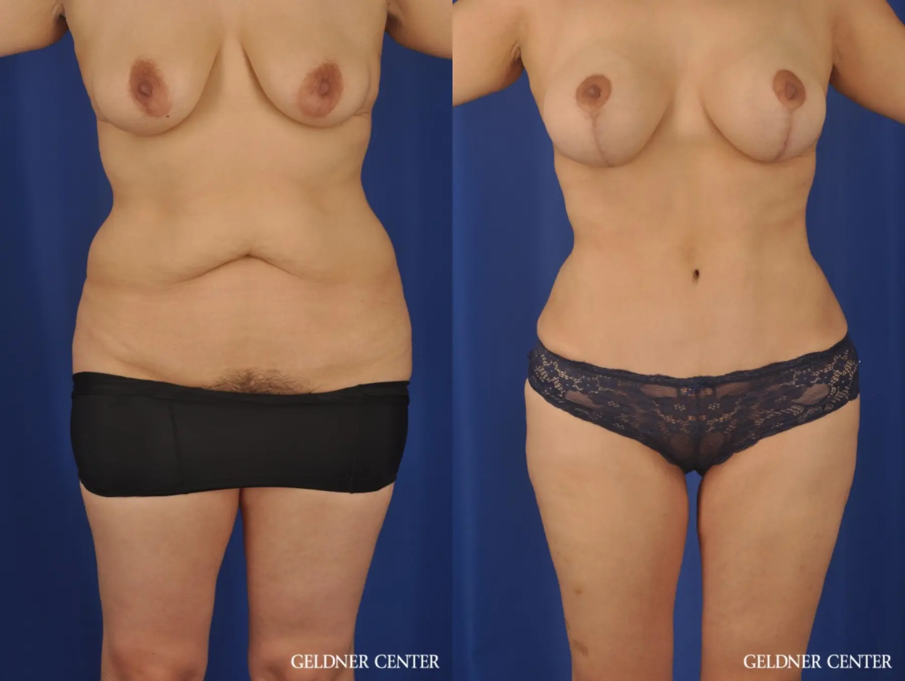 Lipoabdominoplasty: Patient 7 - Before and After 1