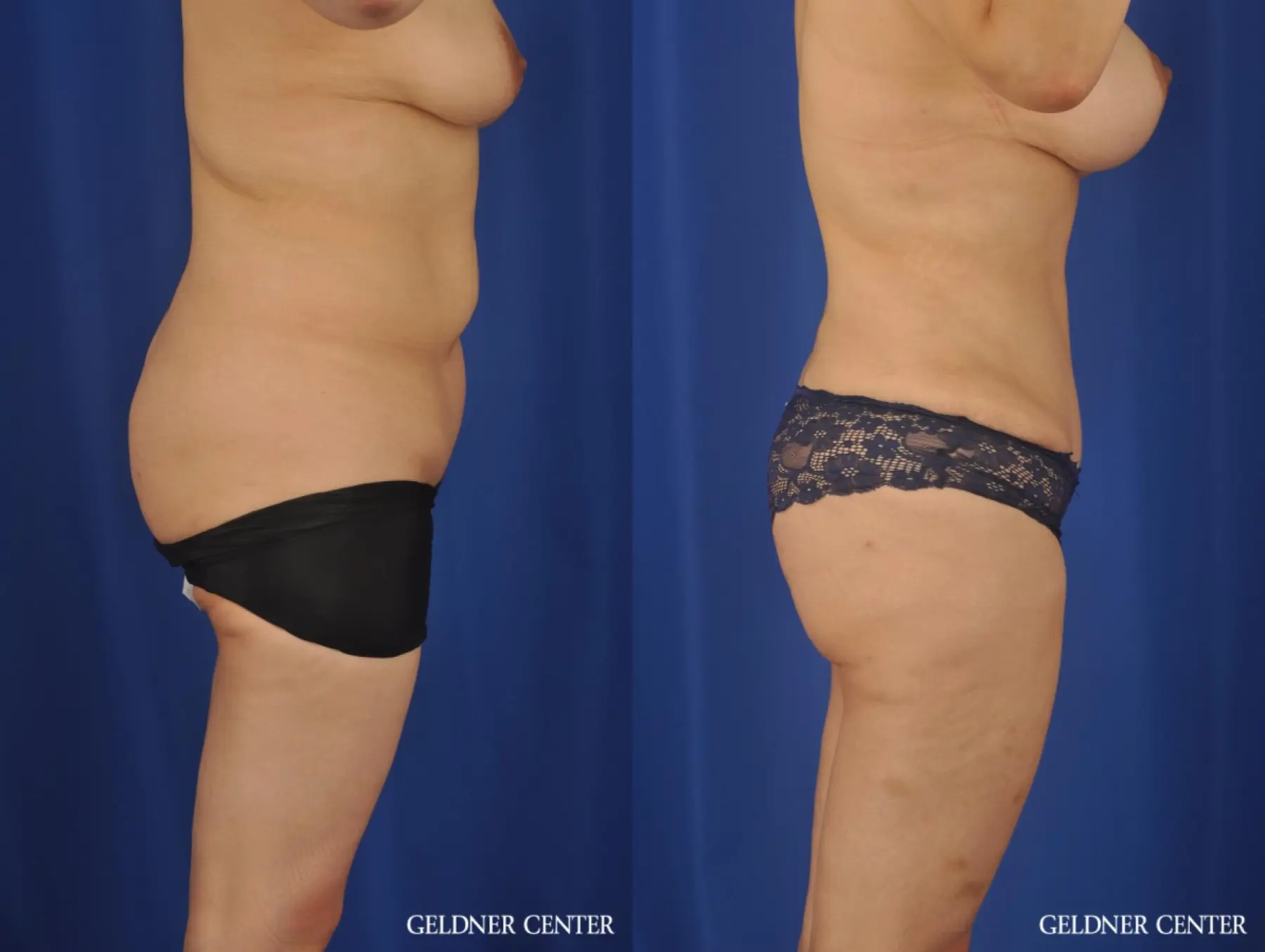 Lipoabdominoplasty: Patient 7 - Before and After 3