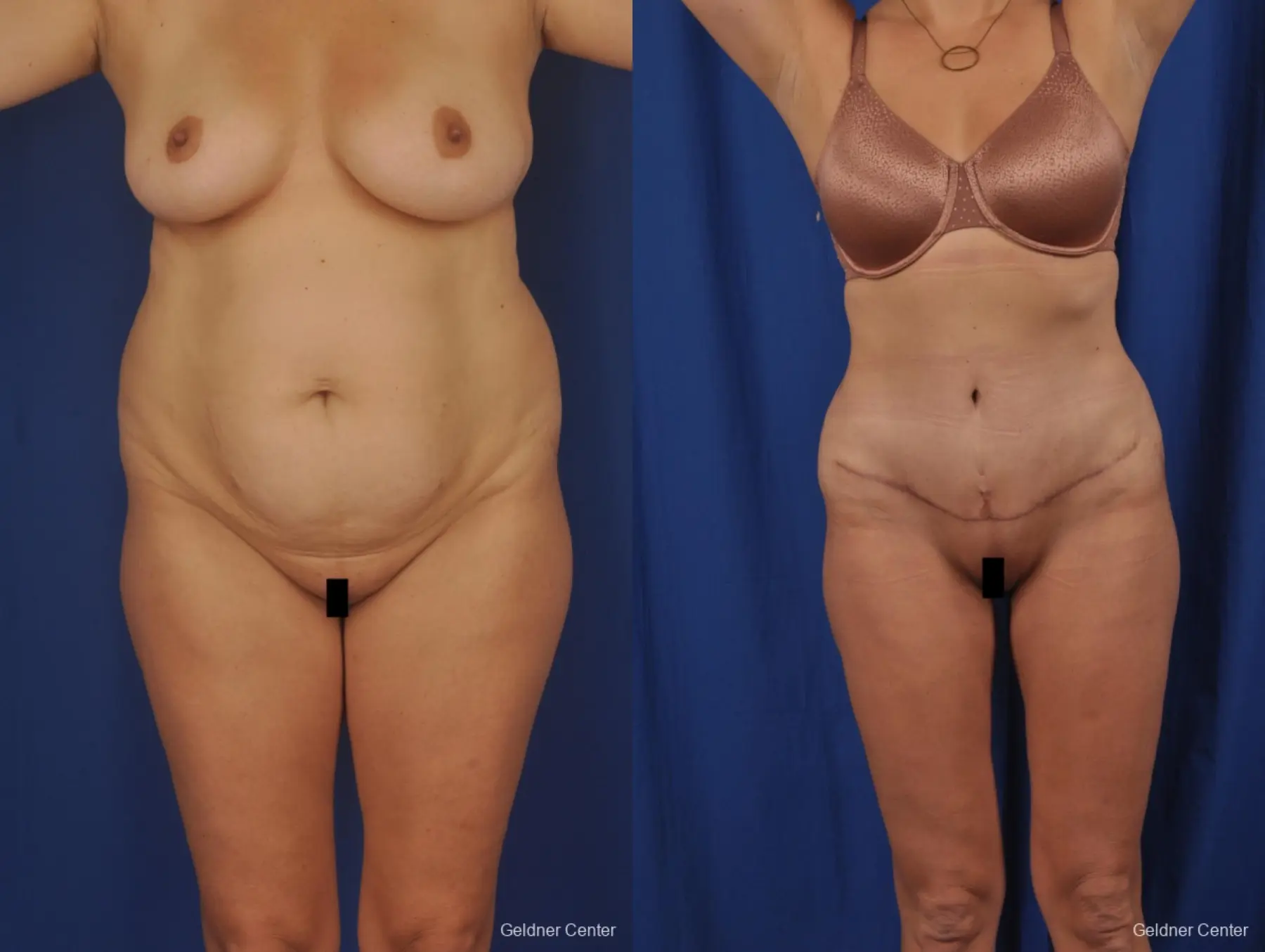 Liposuction: Patient 50 - Before and After  