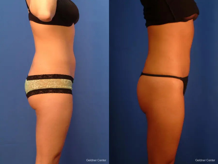 Liposuction: Patient 14 - Before and After 3