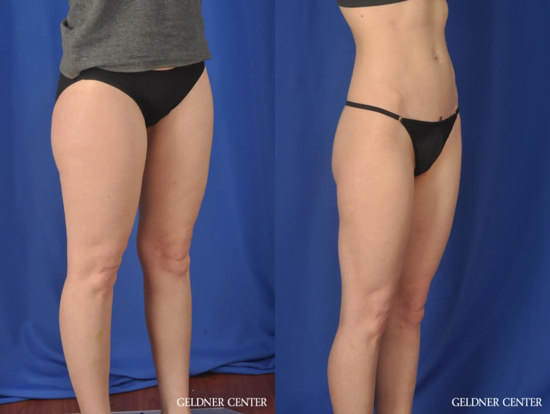 Liposuction: Patient 36 - Before and After 2