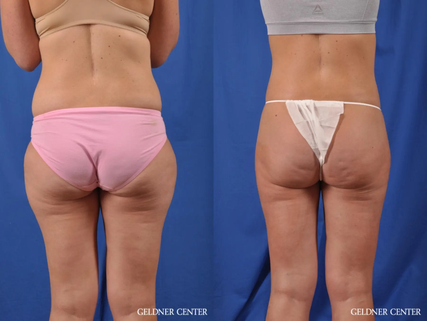 Liposuction: Patient 38 - Before and After 5