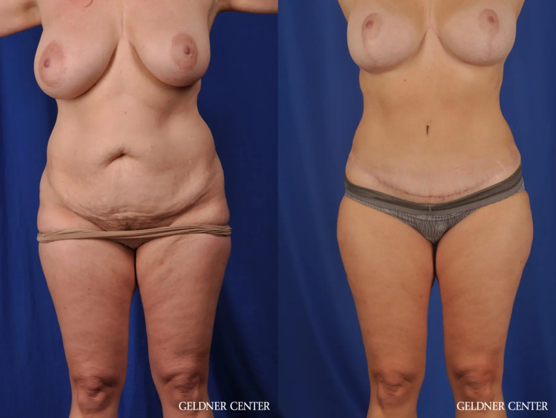 Liposuction: Patient 30 - Before and After  