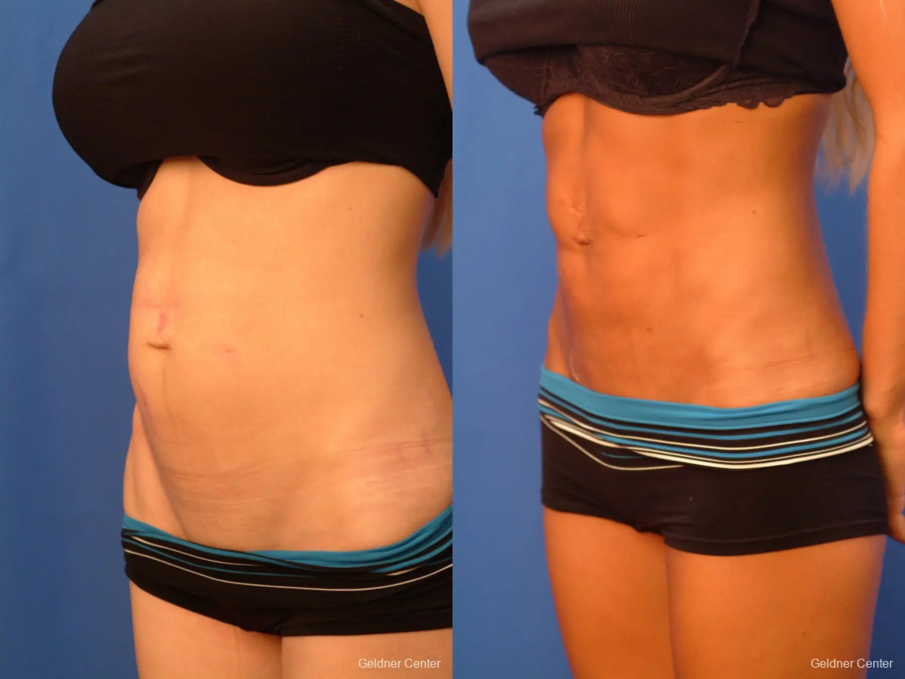  Vaser Liposuction with Abdominal Etching - Before and After 4