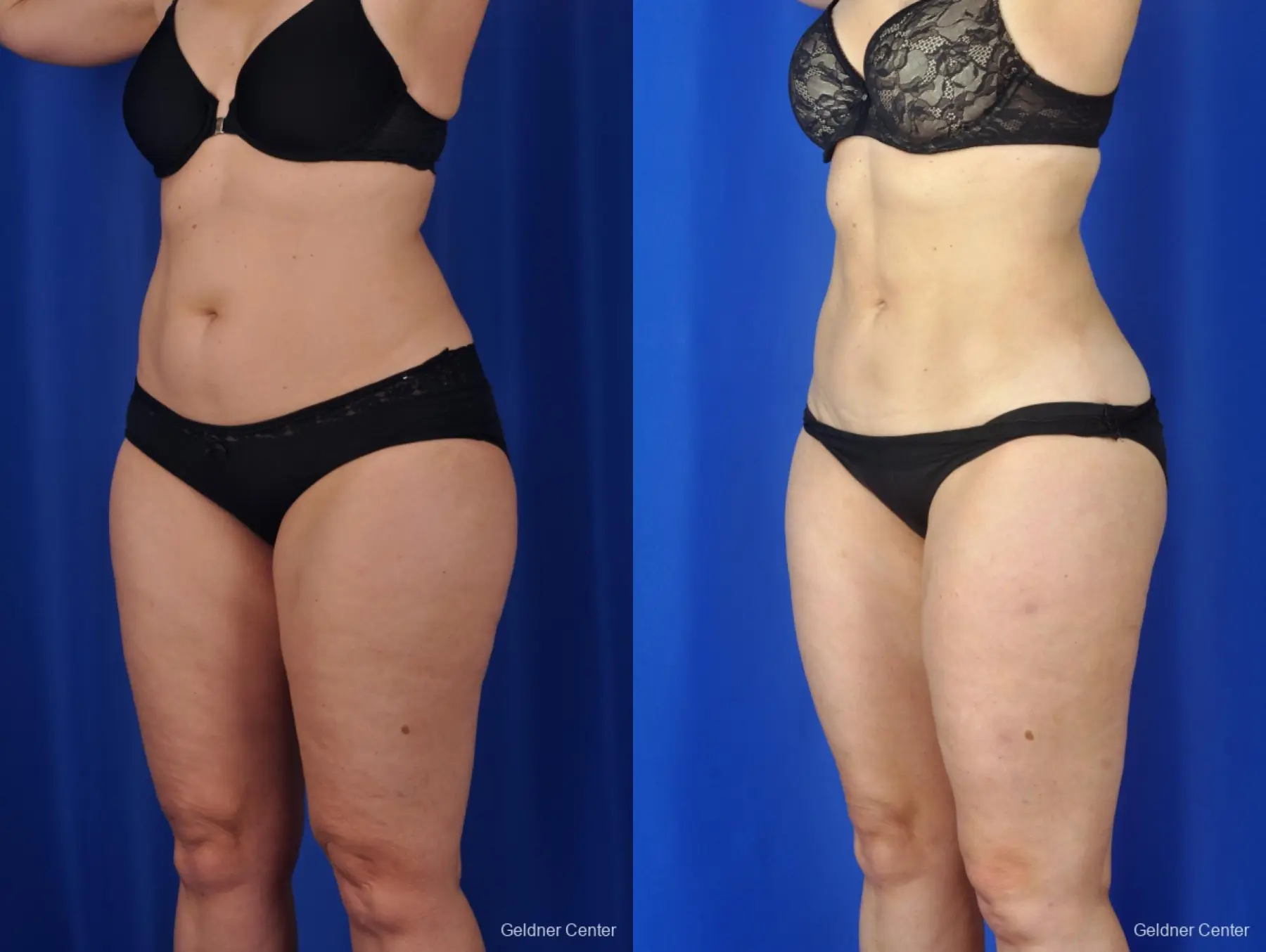 Liposuction: Patient 2 - Before and After 5