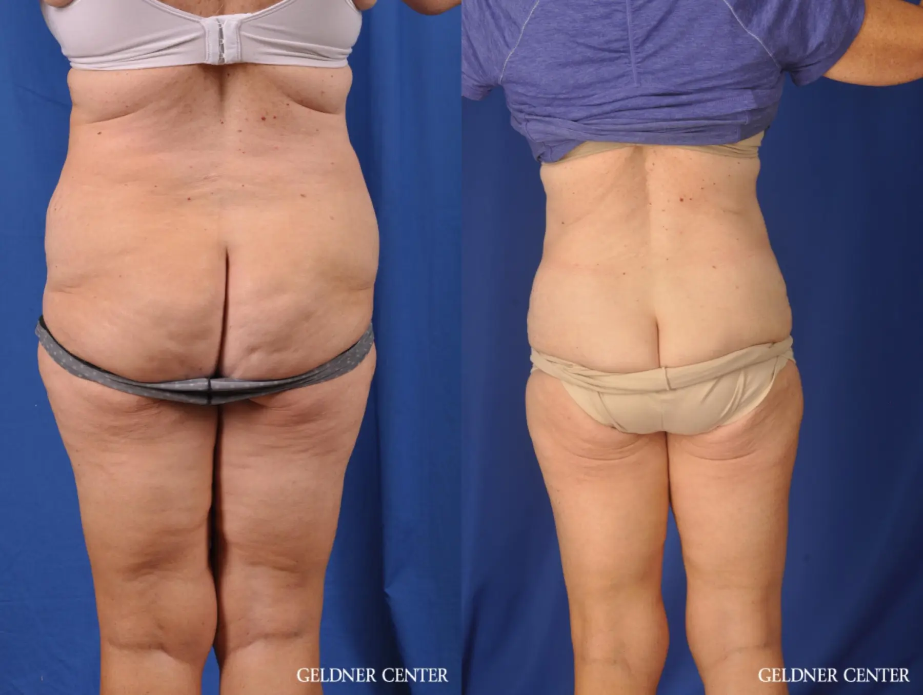 Liposuction: Patient 34 - Before and After 4