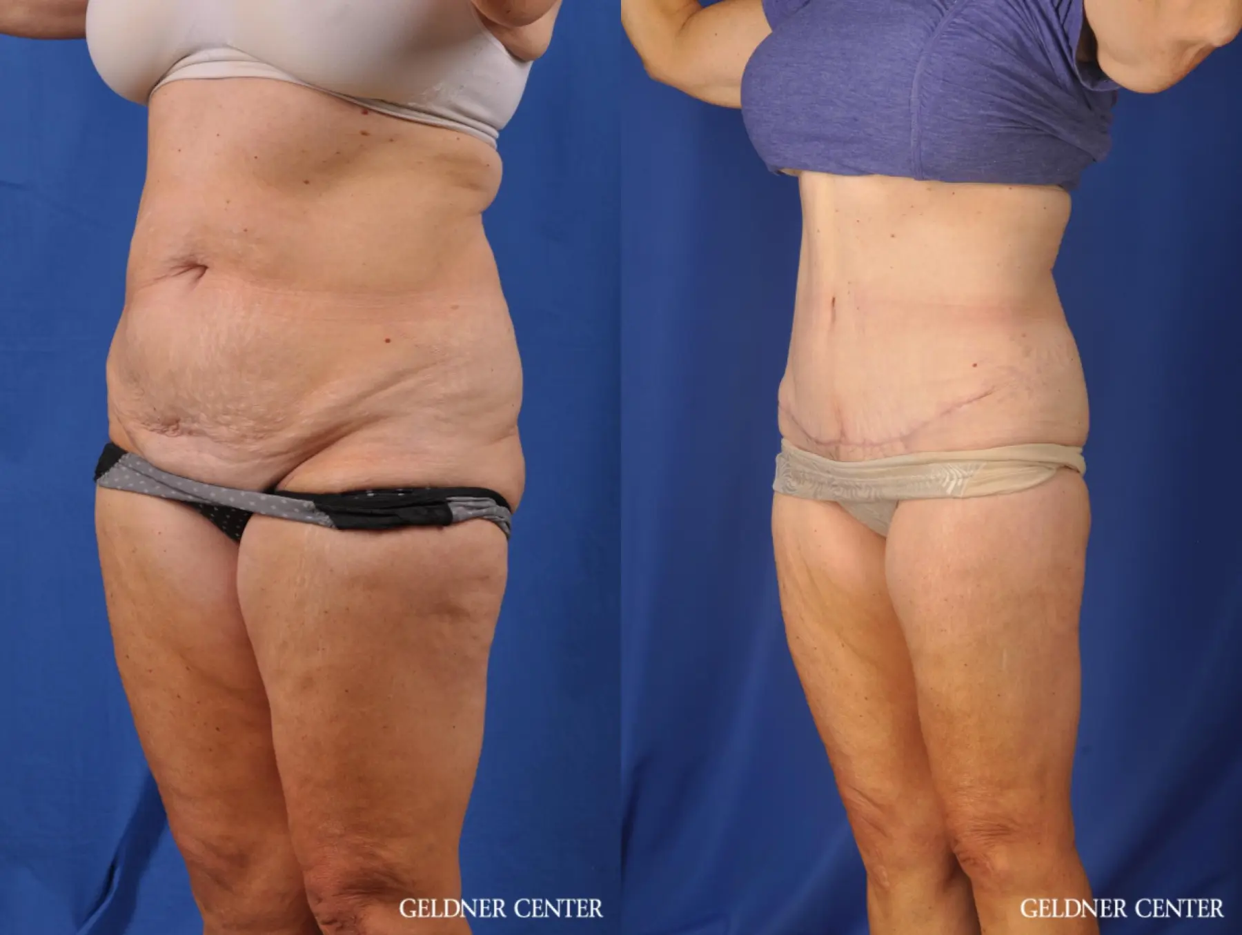 Liposuction: Patient 34 - Before and After 5