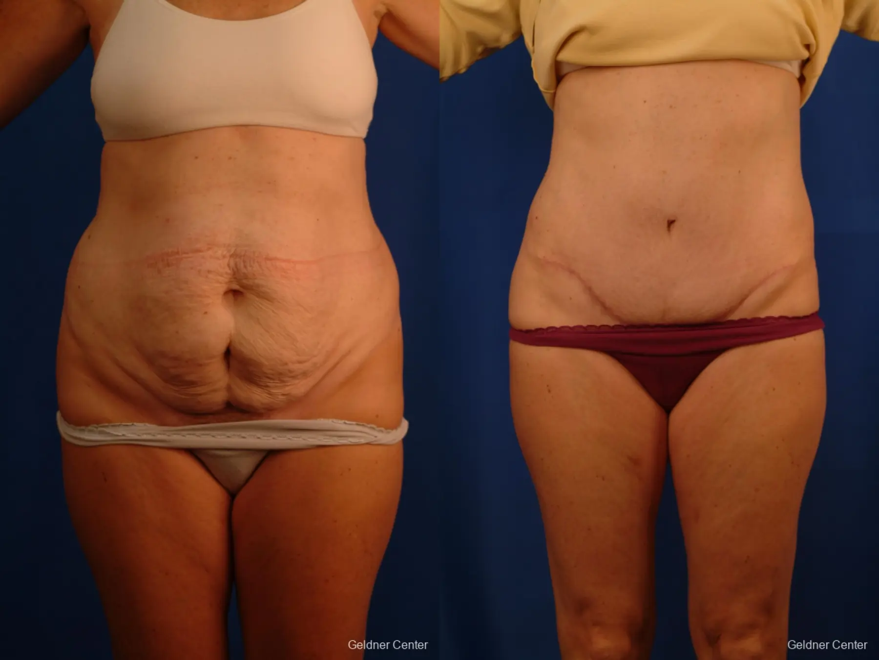 Liposuction: Patient 11 - Before and After  