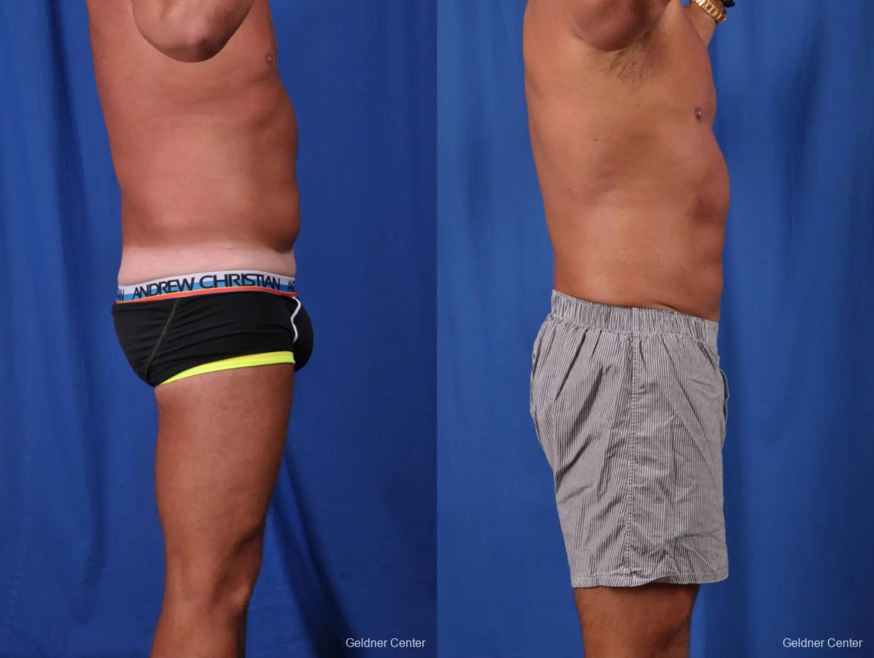 Liposuction For Men: Patient 5 - Before and After 3