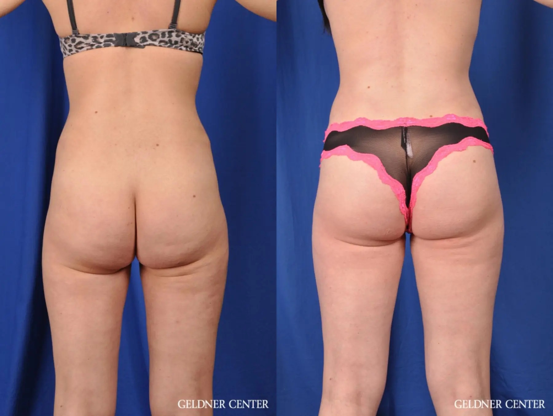Liposuction: Patient 27 - Before and After 3