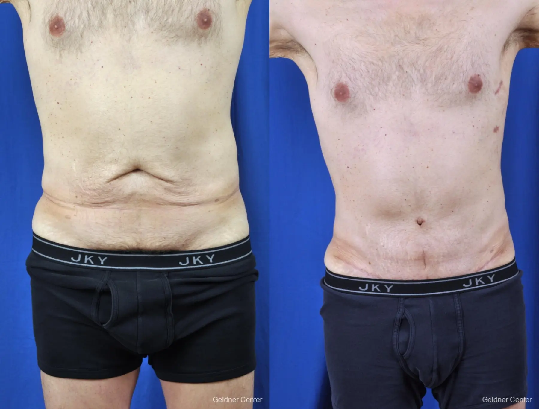 Liposuction For Men: Patient 8 - Before and After 1
