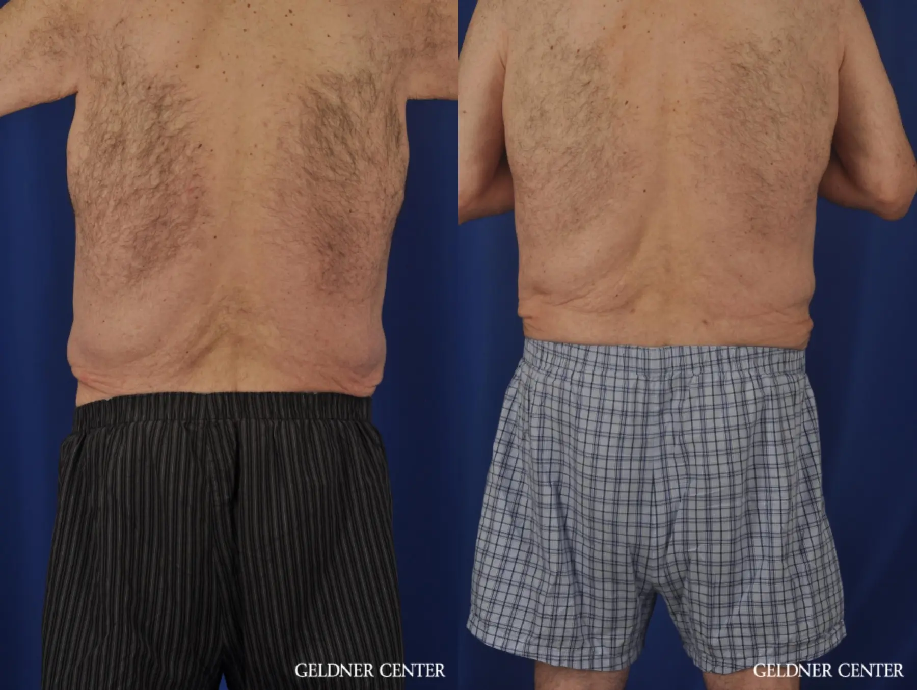Liposuction For Men: Patient 11 - Before and After 4
