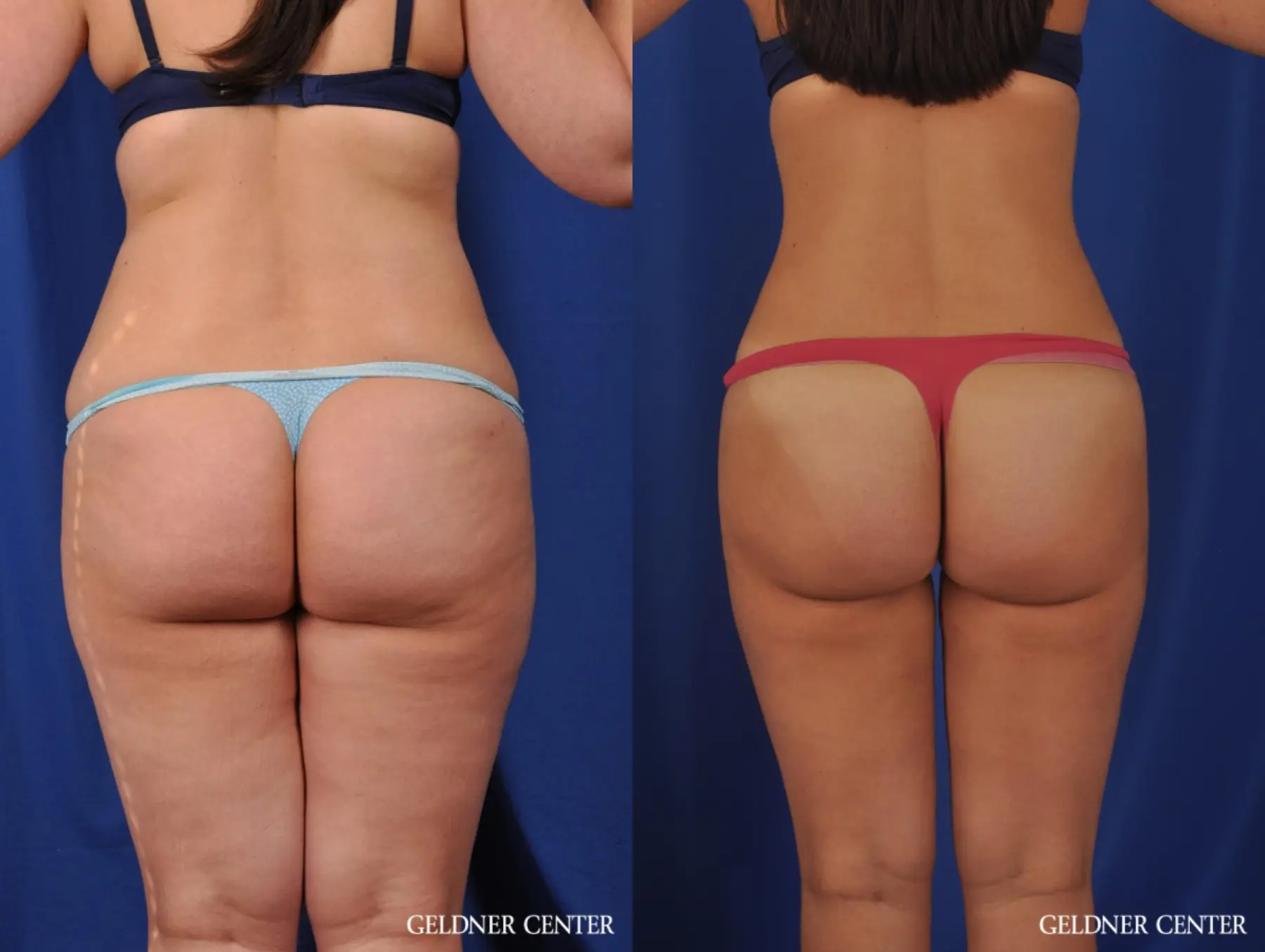 Liposuction: Patient 22 - Before and After 5