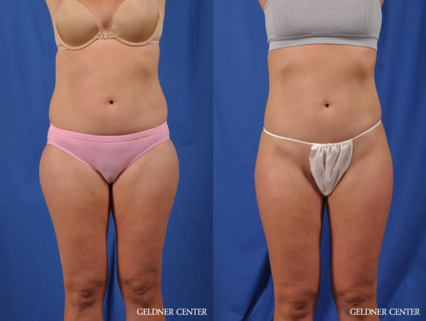 Liposuction: Patient 38 - Before and After  