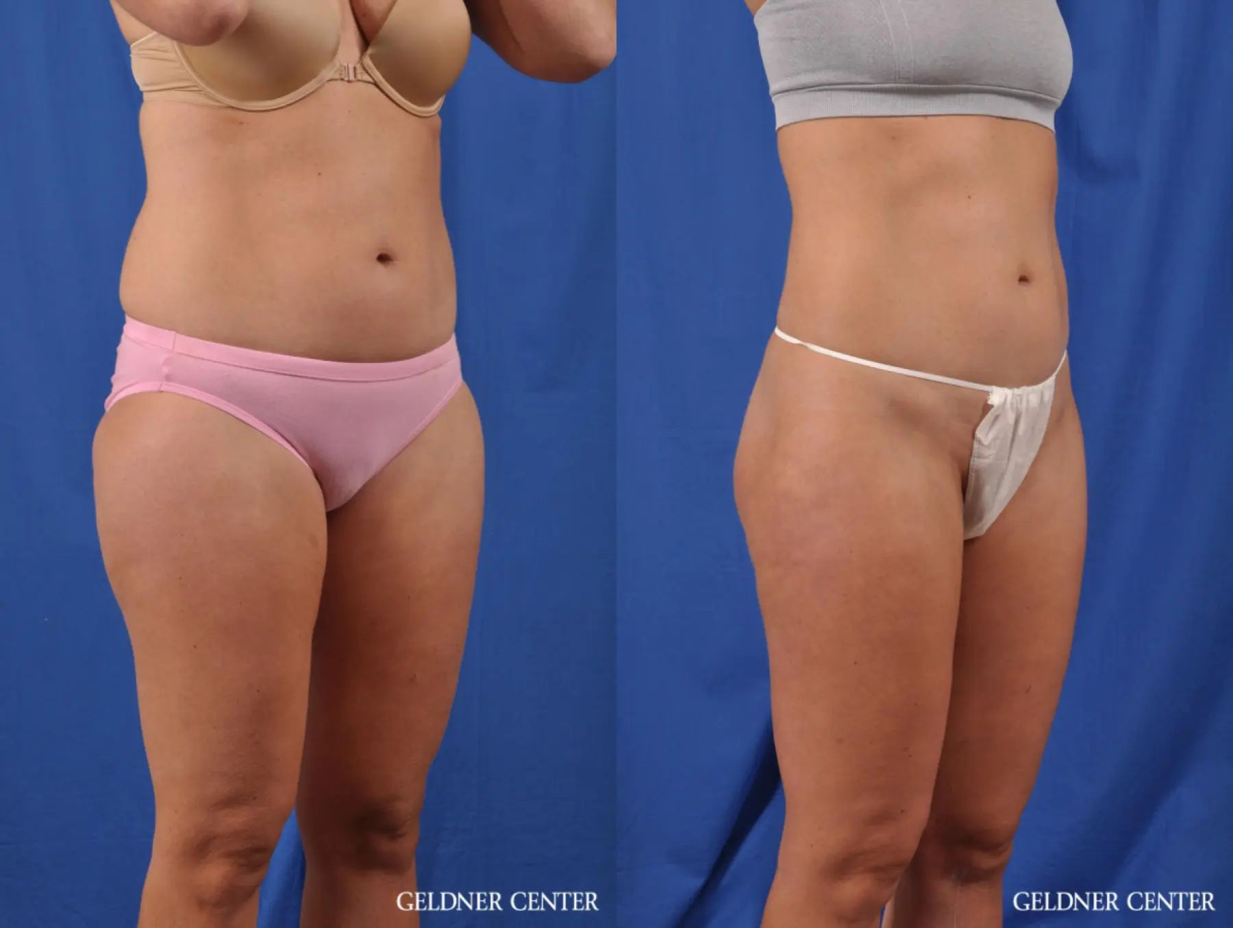Liposuction: Patient 38 - Before and After 2