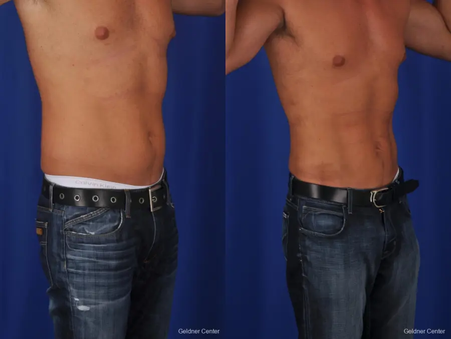 Liposuction For Men: Patient 1 - Before and After 2