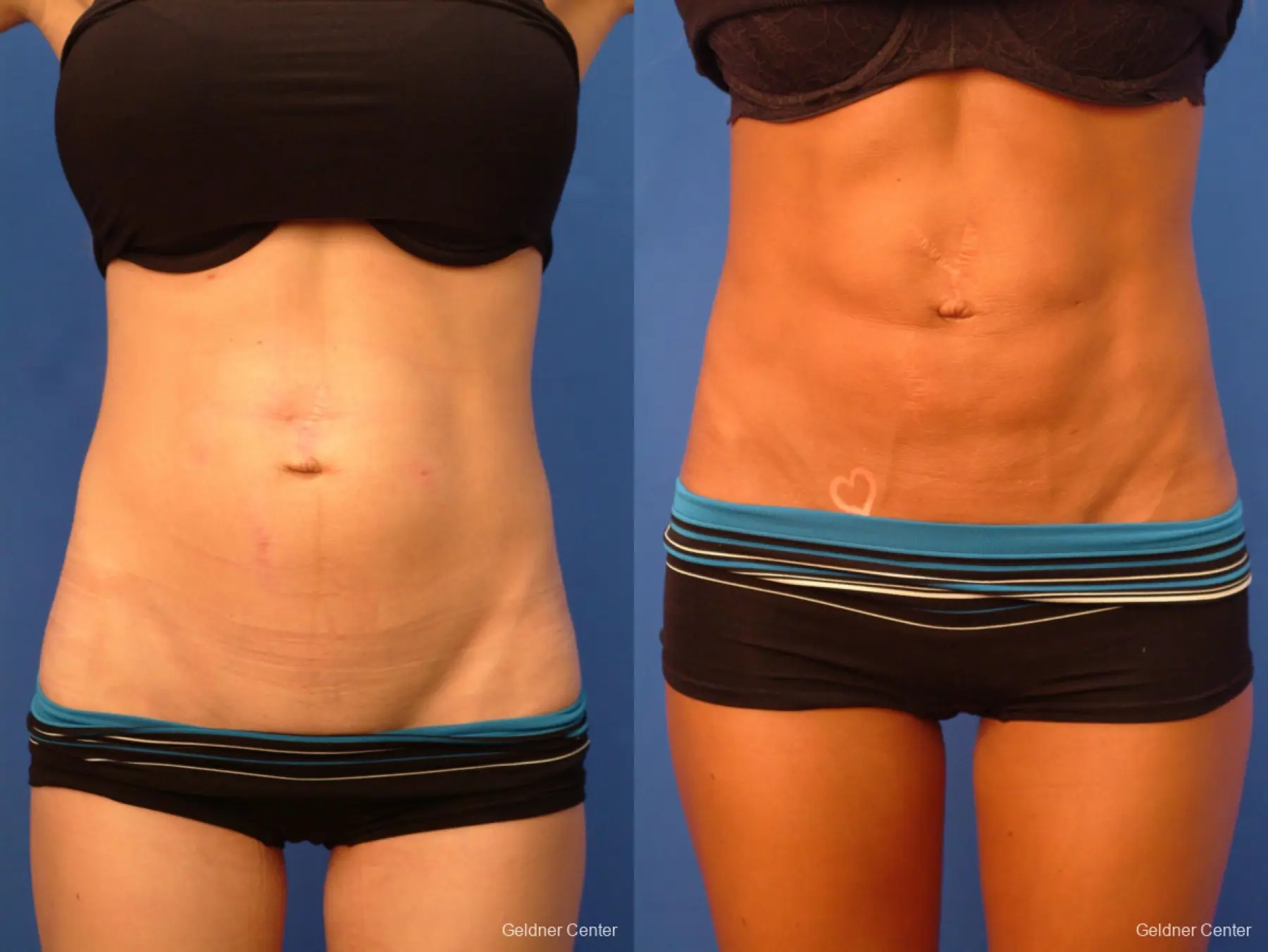  Vaser Liposuction with Abdominal Etching - Before and After 1